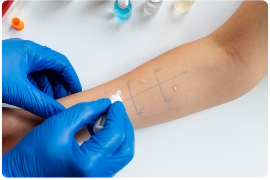 Chikungunya igg test 